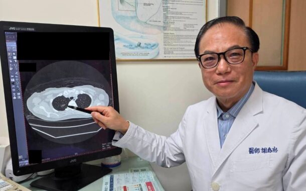 久咳不癒竟藏危機 LDCT助主婦揪出早期肺癌