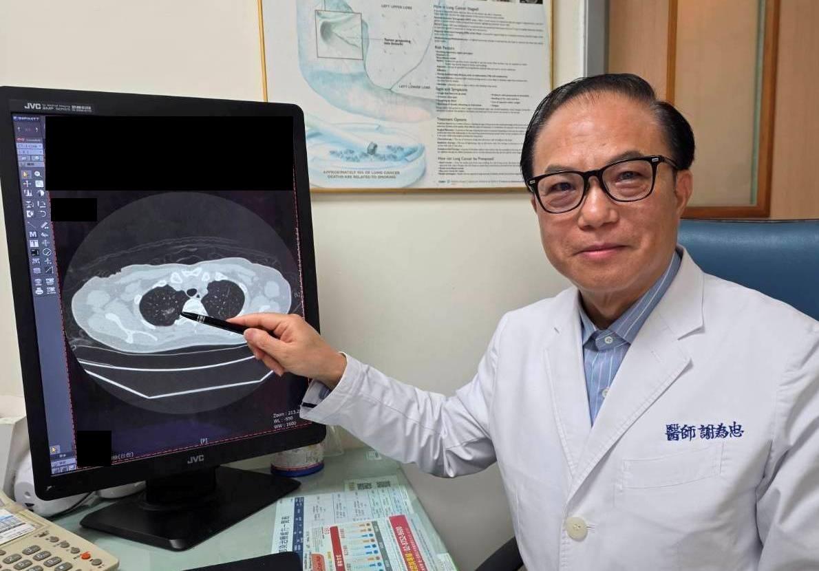 久咳不癒竟藏危機 LDCT助主婦揪出早期肺癌